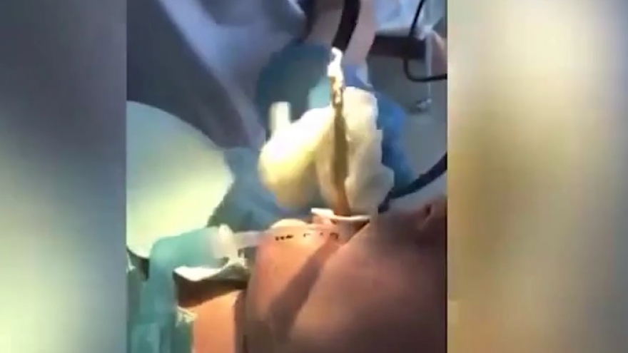 Video: Y bác sĩ lôi con rắn dài 1,2 m khỏi miệng một phụ nữ trẻ